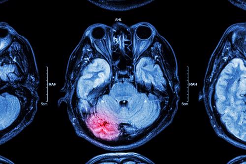 Schedule a CONSULTA GRATUITA with a brain injury lawyer in Nueva York City today.